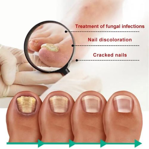 Fast Nail Fungal Treatments Nail Repair Essences Serum