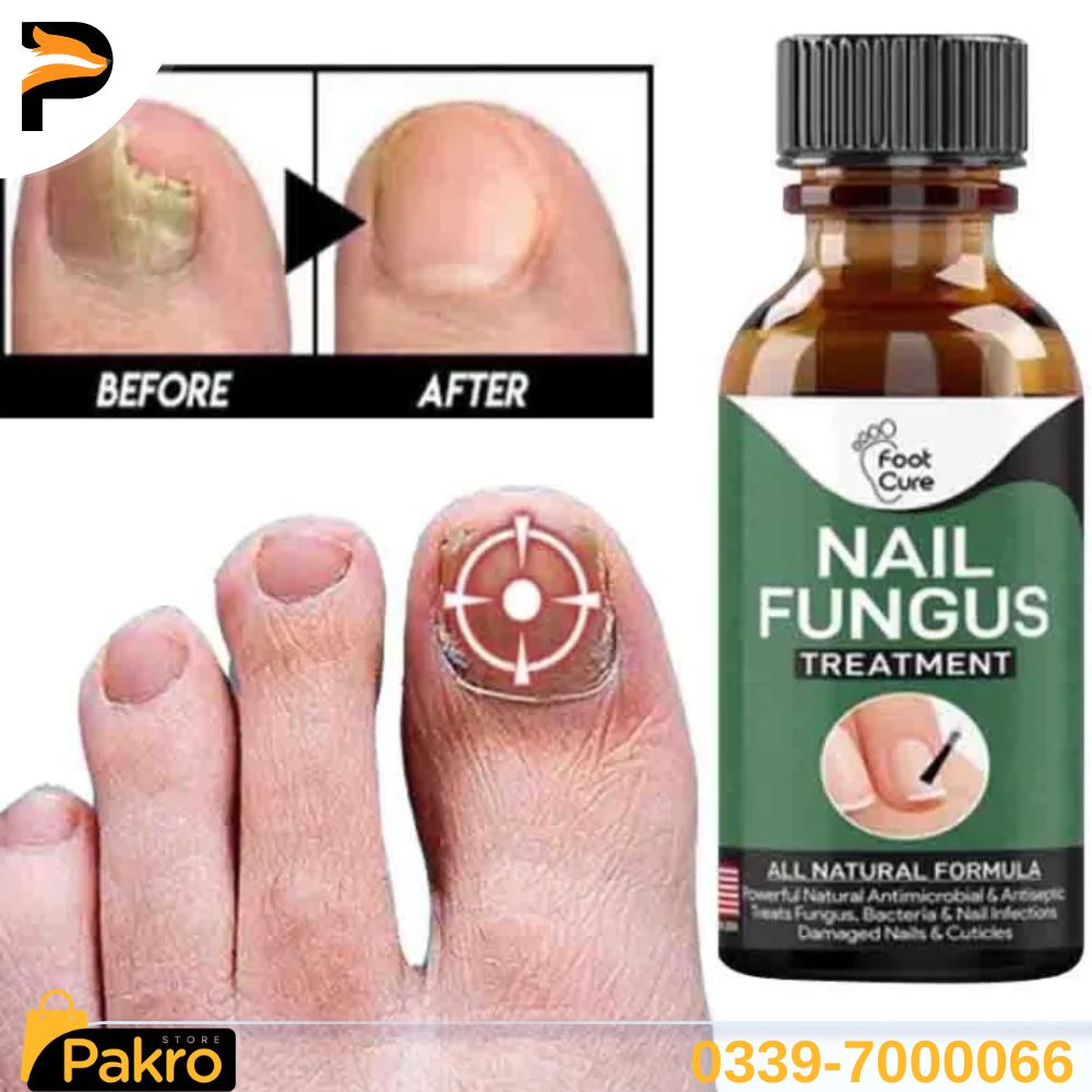 Fast Nail Fungus Treatment Gel – Nail Repair Essence Serum