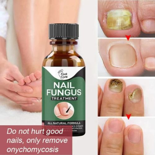 Fast Nail Fungal Treatments Nail Repair Essences Serum