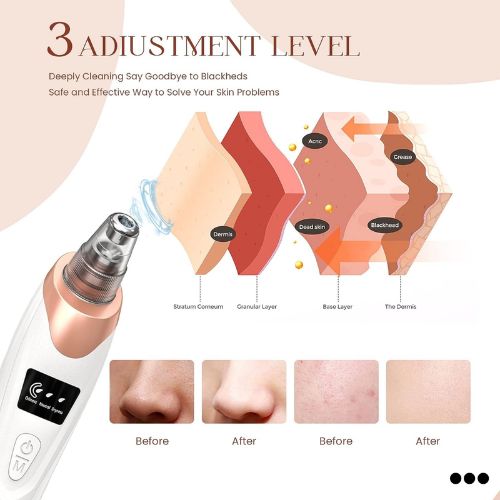 5 in 1 Electric Blackhead Removal Machine - Face Pore Cleaner