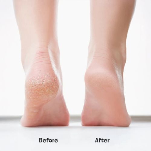 Rechargeable Electric Pedi Foot Filer Effective Callus Remover