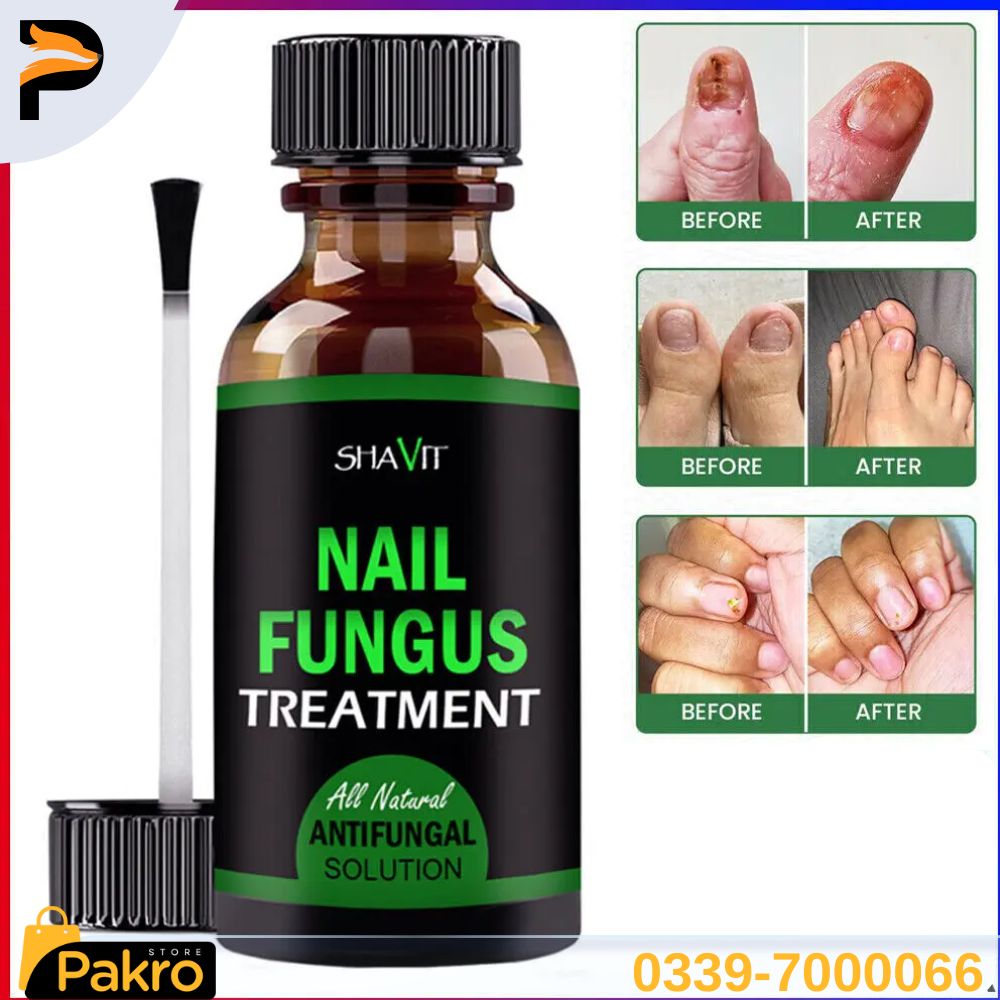 Fast Nail Fungus Treatment Gel – Nail Repair Essence Serum